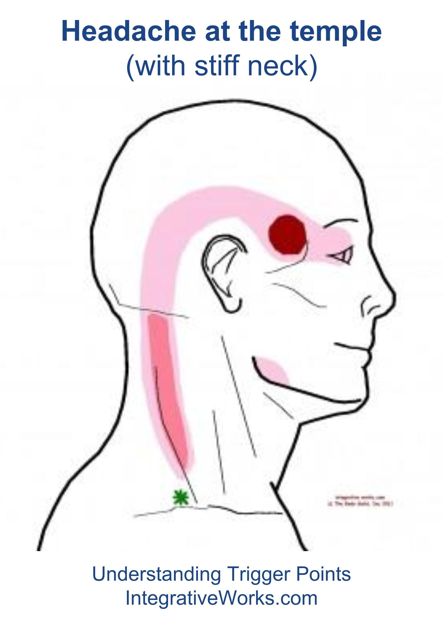 star physical therapy on pin on headache trigger point pain